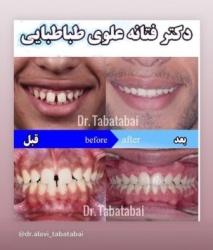 درمان فاصله بین دندانی