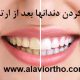 سفید کردن دندانها بعد از ارتودنسی