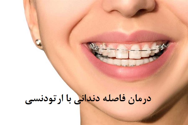 درمان فاصله دندانی با ارتودنسی